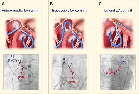 lv summit pvc ablation|ablation of lv summit.